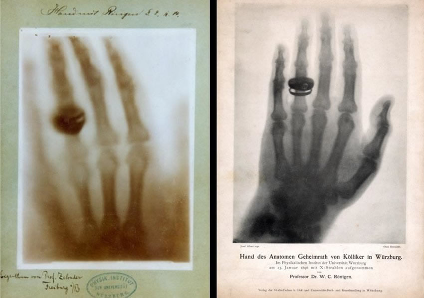 Radiografie mani fatte da Röntgen